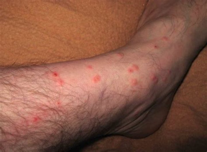 Can a gnat bite cause swelling?