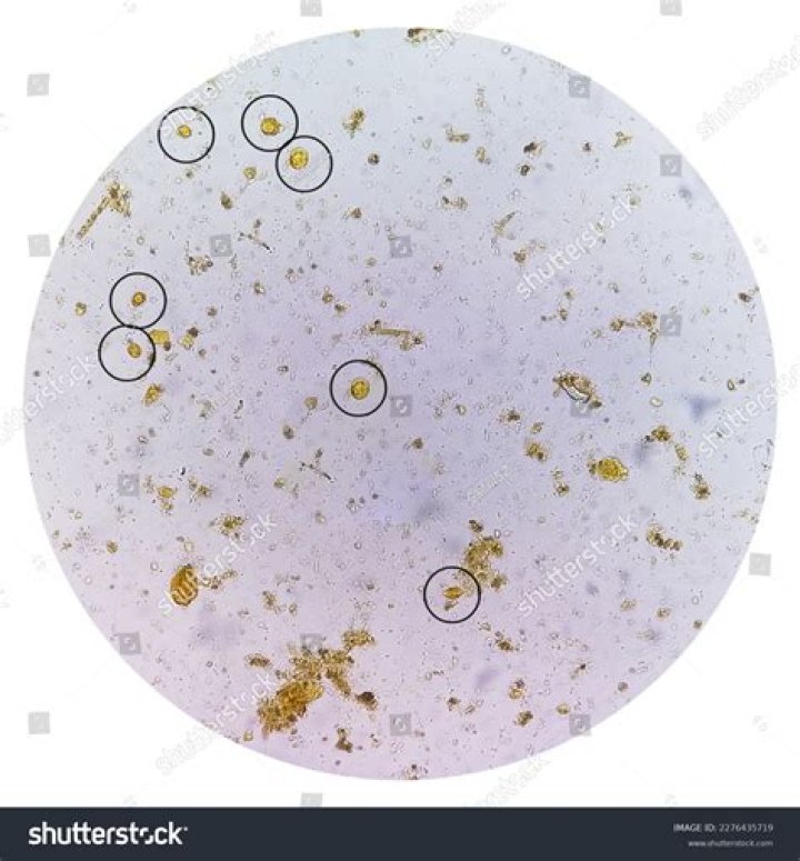 Can blastocystis hominis be cured?