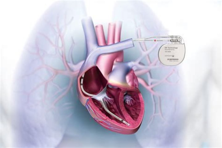 What is an implantable AED?
